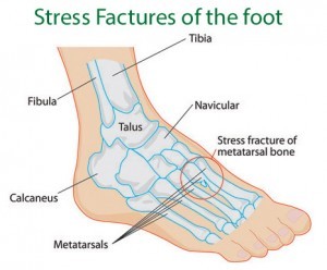 115137313_stress-fractures-foot-pain.jpg